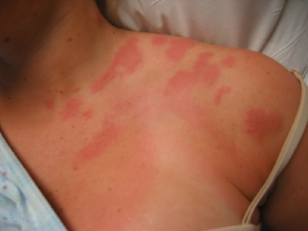 rid of Shingles quickly.