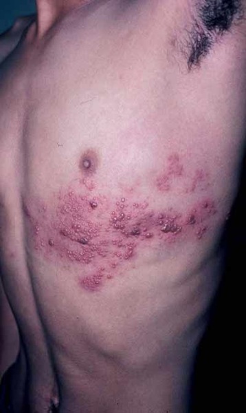 beginning stages of herpes. Symptoms For Proper Healing