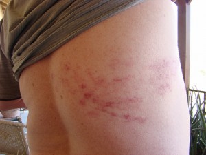 Chicken Pox Shingles