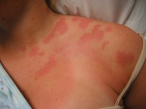 pics of shingles