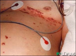 pics of shingles