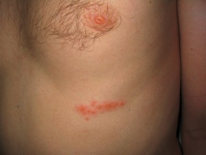 pics of shingles
