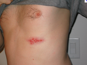 pics of shingles