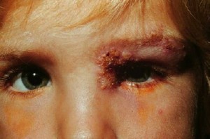 pics of shingles
