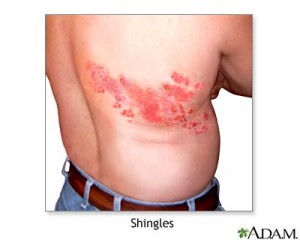 pics of shingles rash