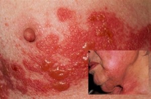 pics of shingles rash