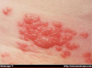pics of shingles rash
