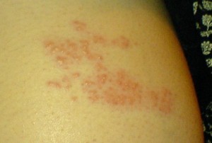 pics of shingles rash