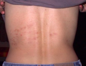 pics of shingles rash