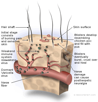 Cure Shingles